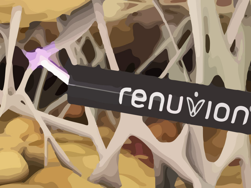aparelho renuvion O que é renuvion?