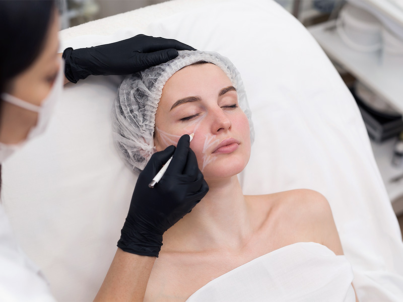 Imagem de uma mulher deitada, dentro do consultório, enquanto uma profissional realiza as marcações em seu rosto antes da aplicação do bioestimulador de colágeno