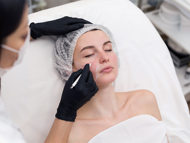 O que são os bioestimuladores de colágeno? Imagem de uma mulher deitada, dentro do consultório, enquanto uma profissional realiza as marcações em seu rosto antes da aplicação do bioestimulador de colágeno