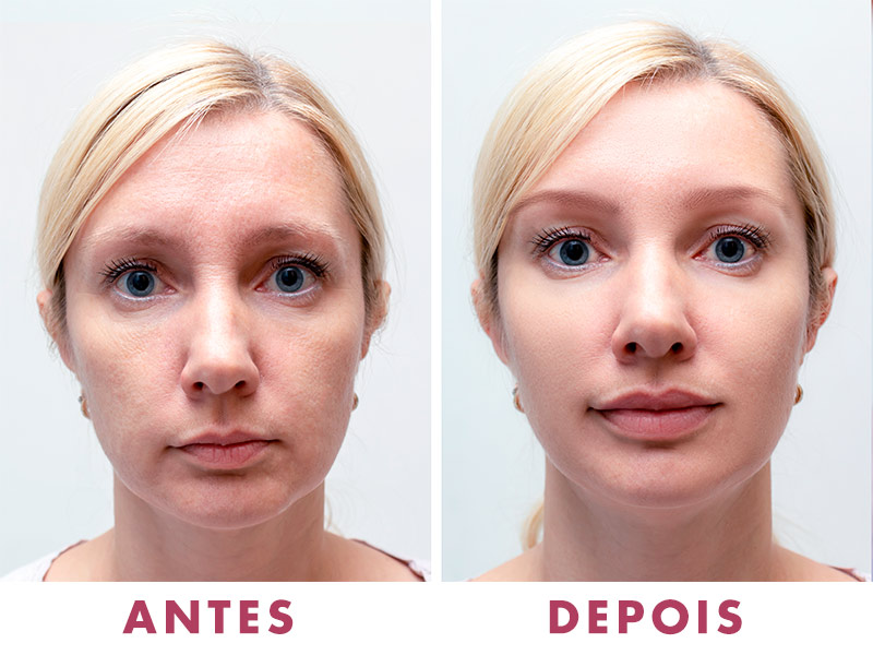 Imagem com o antes e depois do Ellansé no rosto de uma paciente mulher