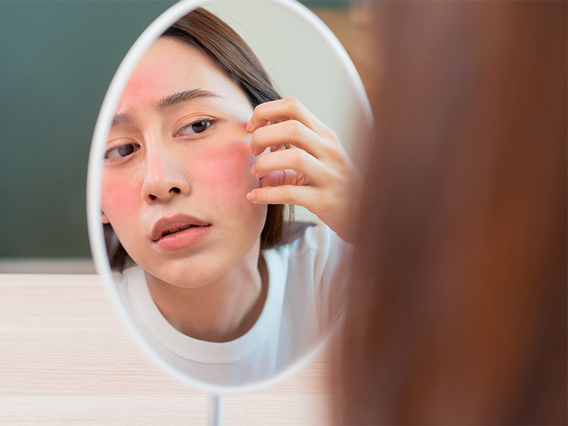 Imagem de uma mulher com leve vermelhidão no rosto se olhando no espelho