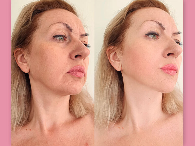 Sculptra - Antes e depois do bioestimulador de colágeno | Dream Plastic
