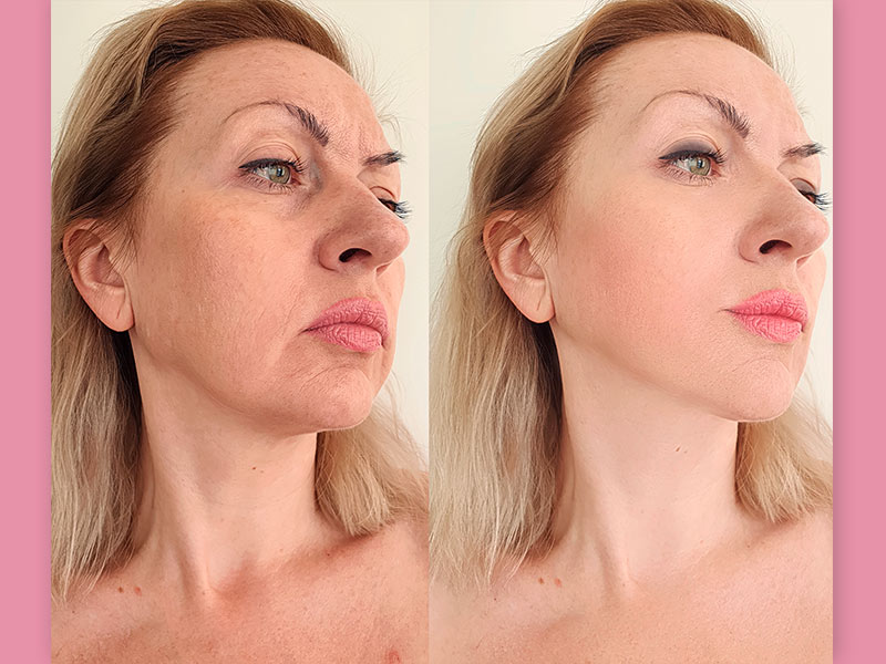 Imagem do antes e depois do sculptra no rosto de uma mulher