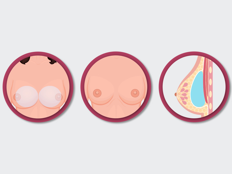 ilustração com o passo a passo da cirurgia de simastia