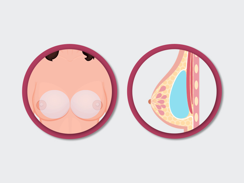 ilustração demonstrando como fica alojada a prótese antes e depois da simastia