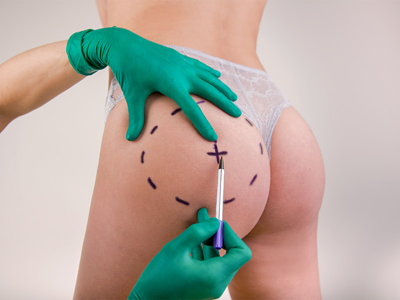 Imagem de um profissional de saúde realizando as marcações nos glúteos de uma paciente para realizar o preenchimento 
