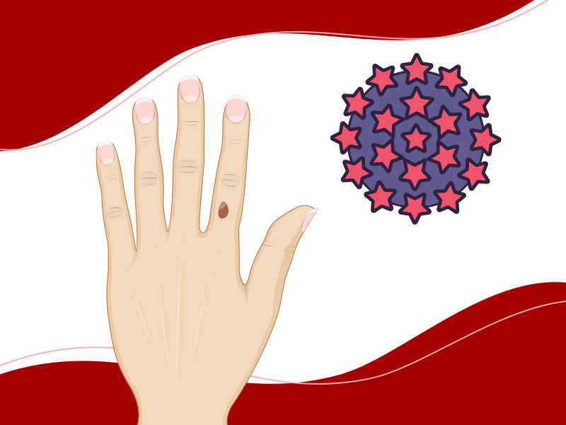 Ilustração de uma mão com berruga e um vírus ao lado 