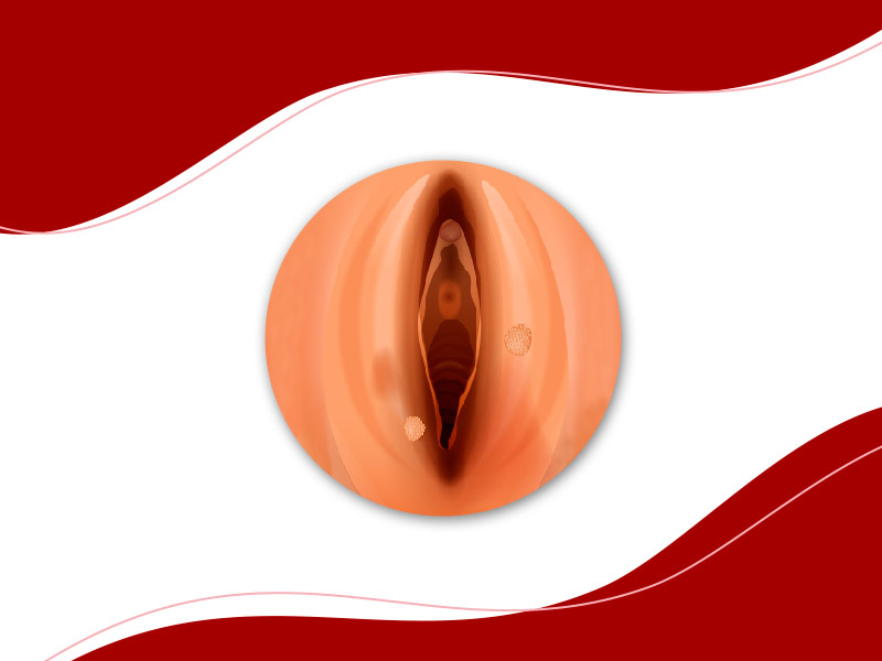 Ilustração de uma vagina com verrugas