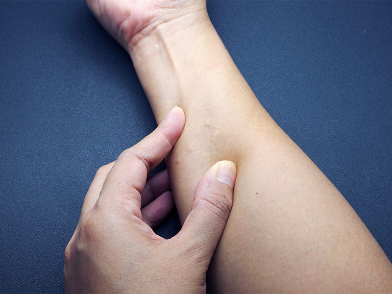 Homem apertando a pele do braço para mostrar os sintomas do cisto sebáceo