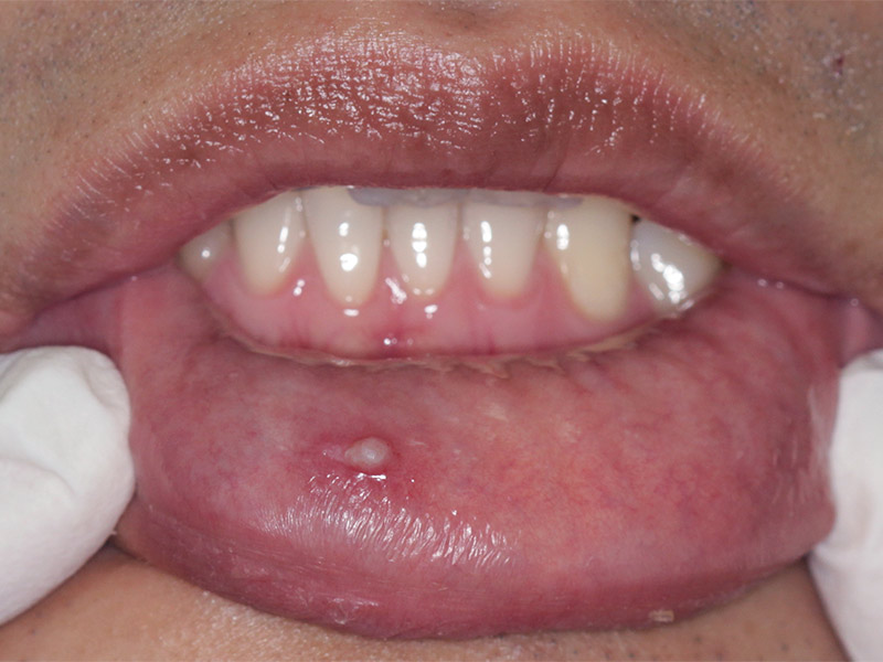 Imagem de uma pessoa com verrugas na boca