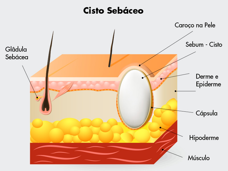 Ilustração que mostra a estrutura do cisto sebáceo no corpo