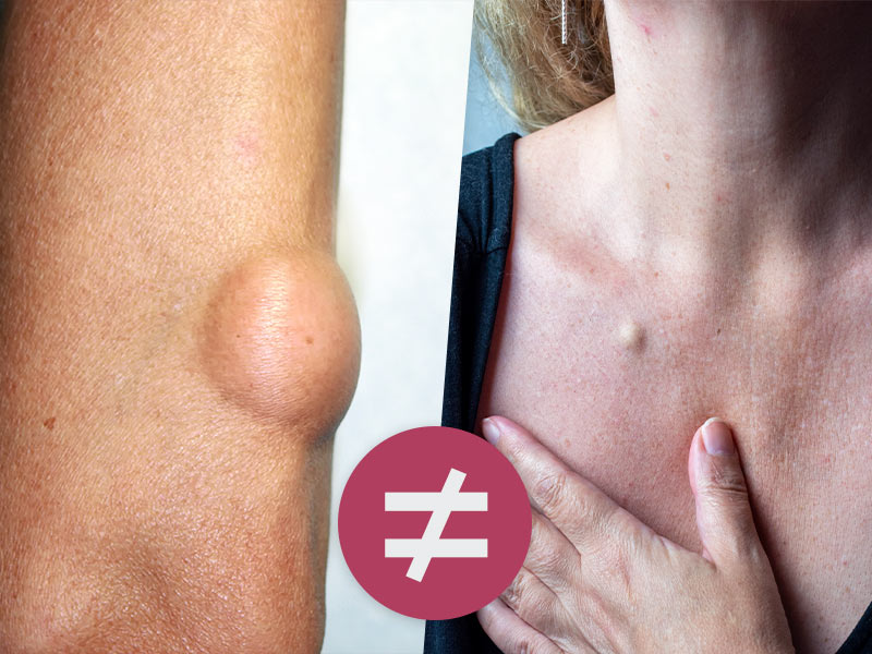 Duas imagens, para mostrar a diferença entre cisto sebáceo e lipoma