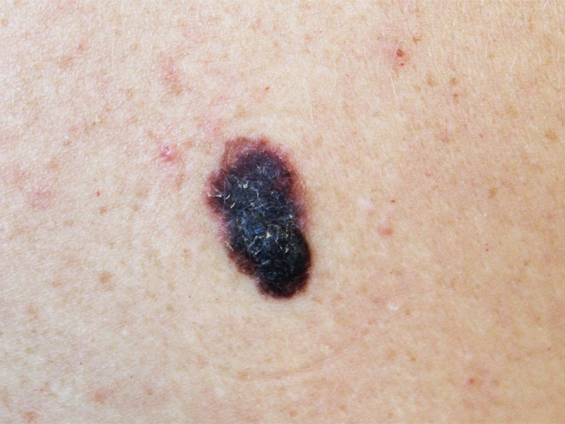 Imagem de um câncer de pele