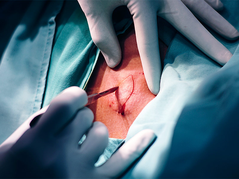 Cirurgia de remoção do cisto sebáceo