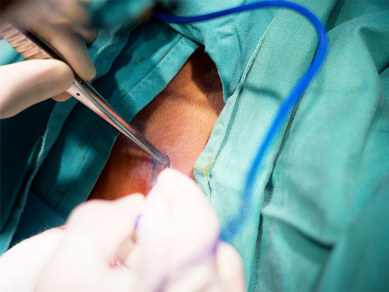 Imagem de um especialista fazendo a identificação de uma verruga no paciente