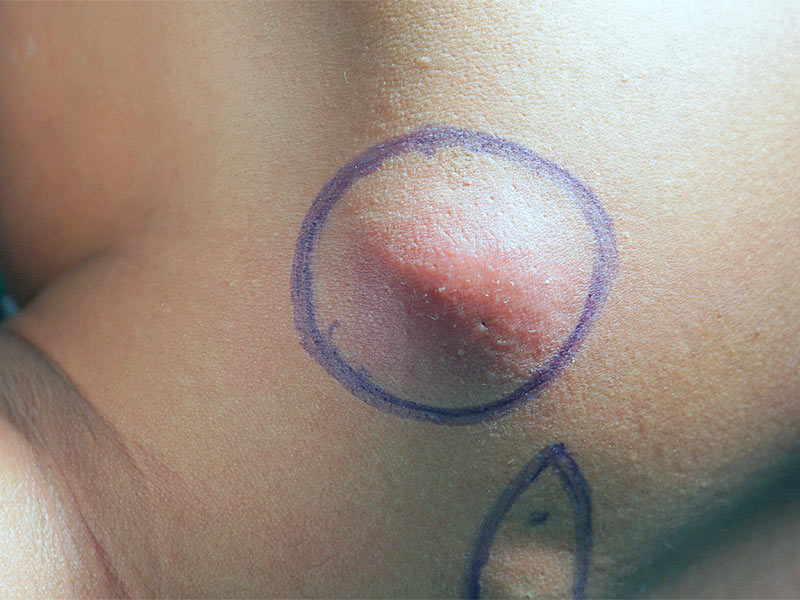 Marcação de caneta azul em volta do cisto epidérmico para a cirurgia de remoção