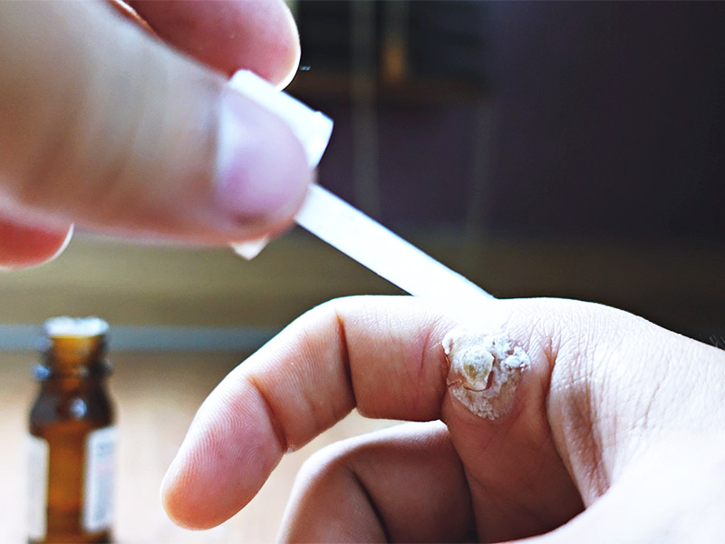 Imagem de uma pessoa aplicando ácido em uma verruga na mão