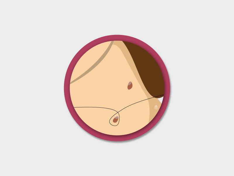 É seguro remover verrugas com linha? Ilustração exemplificando como é feita a remoção das verrugas com linha, um método que não é recomendado pelos médicos