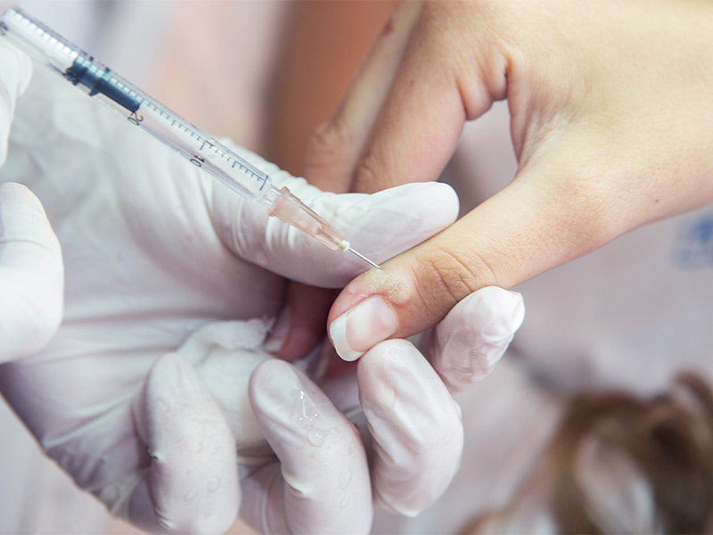 Imagem de uma mão com verruga no dedo e um especialista aplicando uma injeção na lesão 