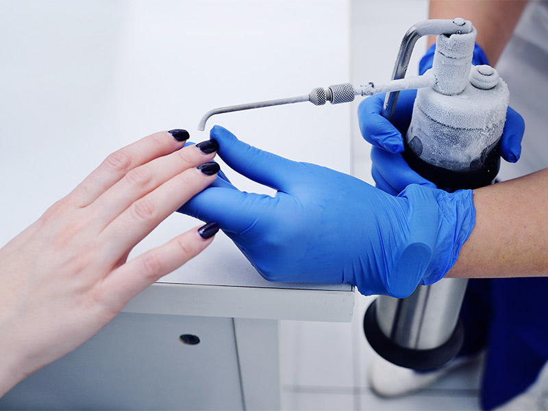 Imagem de uma mão com verrugas nos dedos e uma profissional segurando o aparelho de crioterapia para iniciar o tratamento 