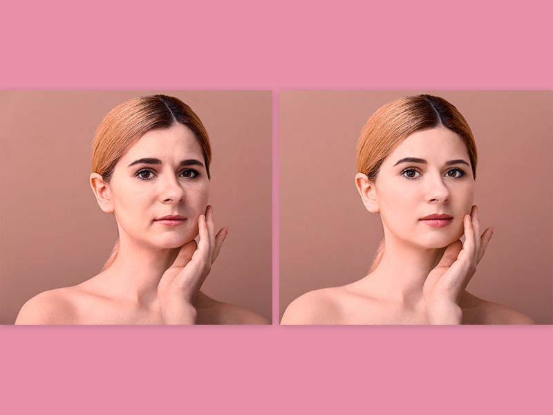 Imagem com fundo rosa e fotos do antes e depois de uma paciente com o pmma no rosto