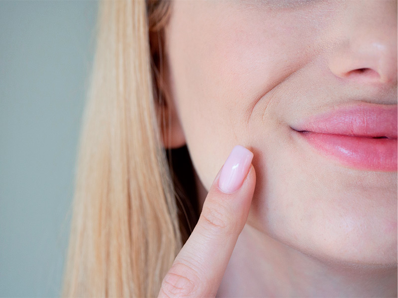 Imagem de uma mulher esboçando um sorriso, com os lábios fechados e apontando o dedo indicador para a região do bigode chinês com preenchimento de pmma
