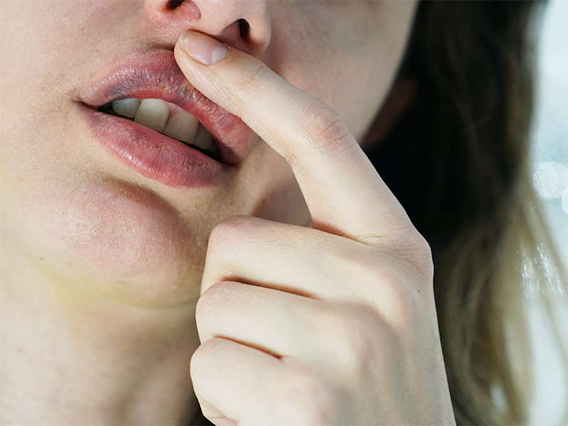 Imagem de uma mulher com os lábios cinza-azulados, um dos sinais de necrose após preenchimento com pmma