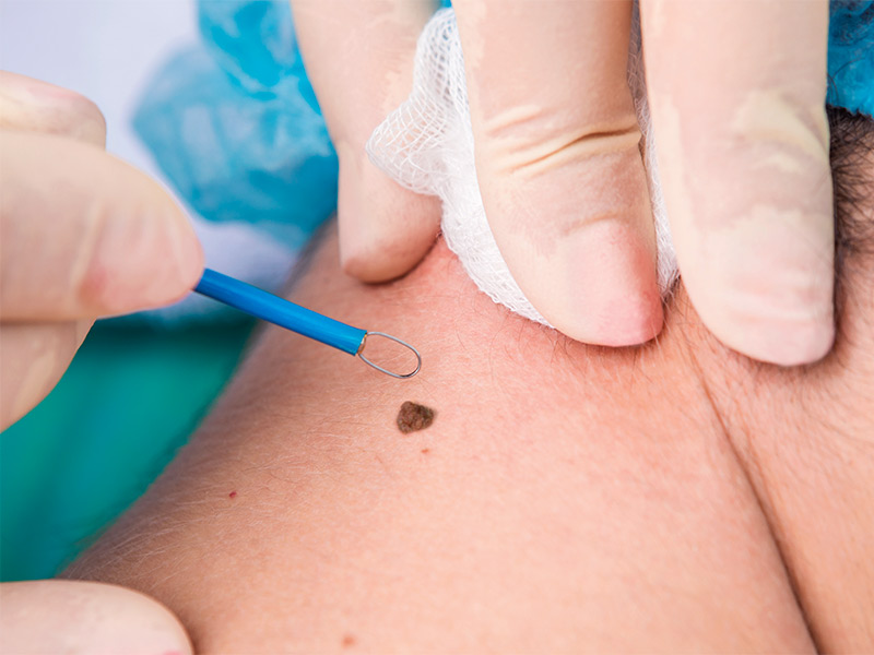 Saiba como é o processo de curetagem ou shaving para tirar pintas curetagem tirar pintas