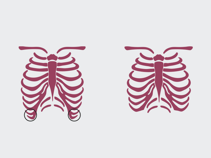 ilustração mostrando como seria a cirurgia para tirar costela