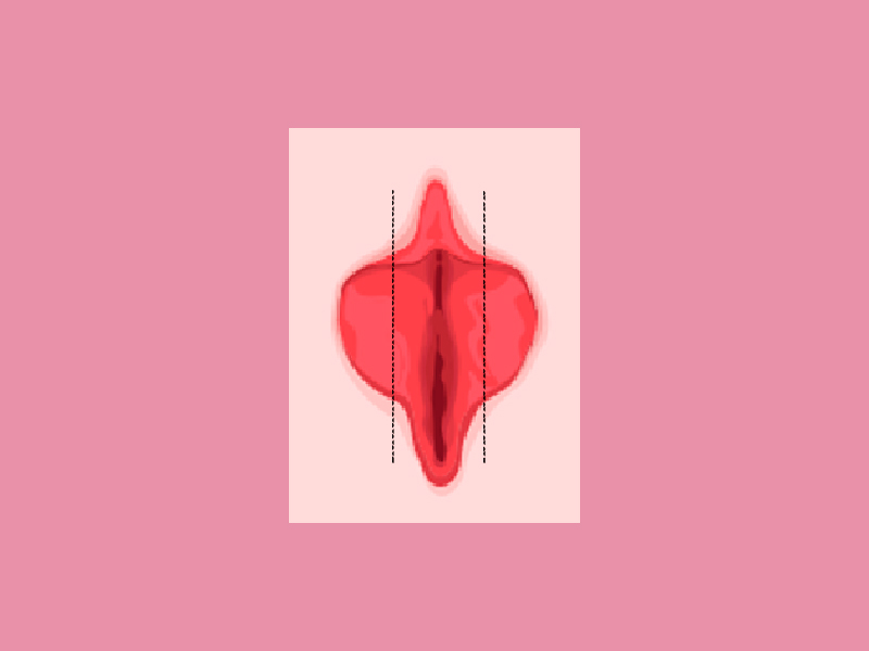 Saiba como fica a cicatriz da ninfoplastia cicatriz ninfoplastia