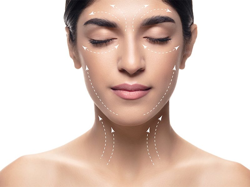 Imagem de uma mulher com marcações no rosto e pescoço, indicando os lugares onde o facelift costuma ser realizado