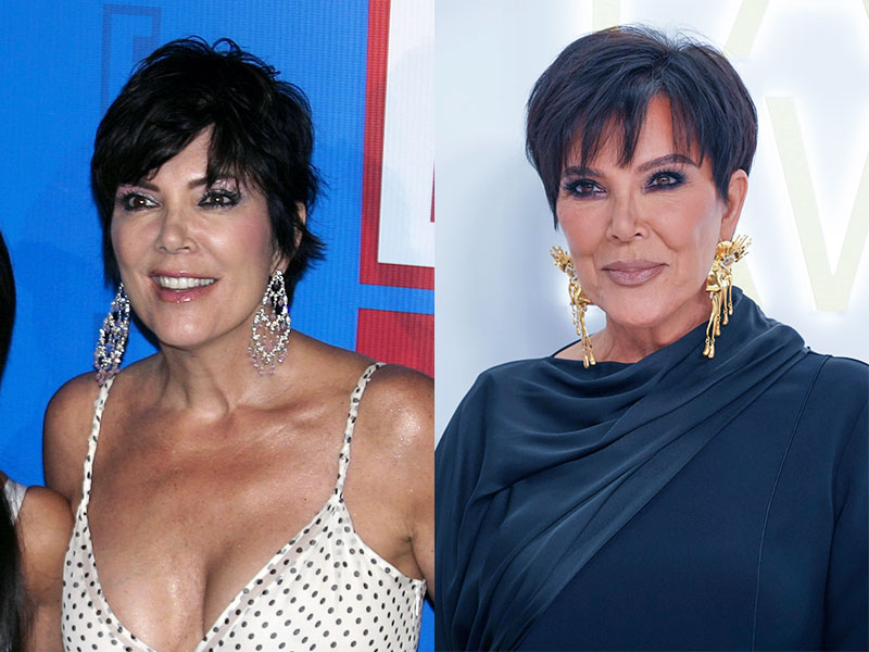 antes depois lifting facial kris jenner