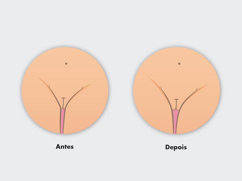 resultado preenchimento dos grandes lábios