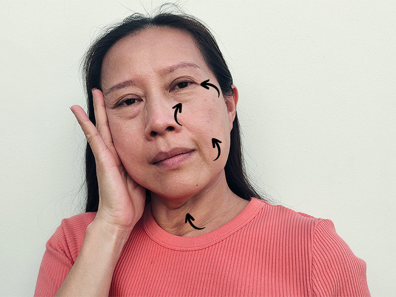 Imagem de uma mulher com flacidez no rosto. Na foto, há setas em diferentes partes de seu rosto e pescoço sinalizando os locais onde a flacidez é mais acentuada.