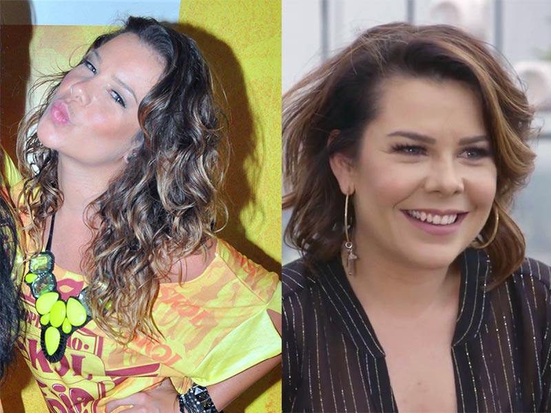 Imagem com o antes e depois da radiofrequência realizada pela atriz Fernanda Souza