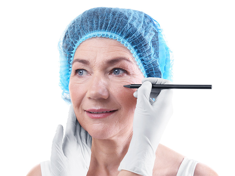 Imagem de uma paciente recebendo as marcações faciais antes de realizar a cirurgia plástica no rosto para retirar o excesso de pele e as rugas profundas