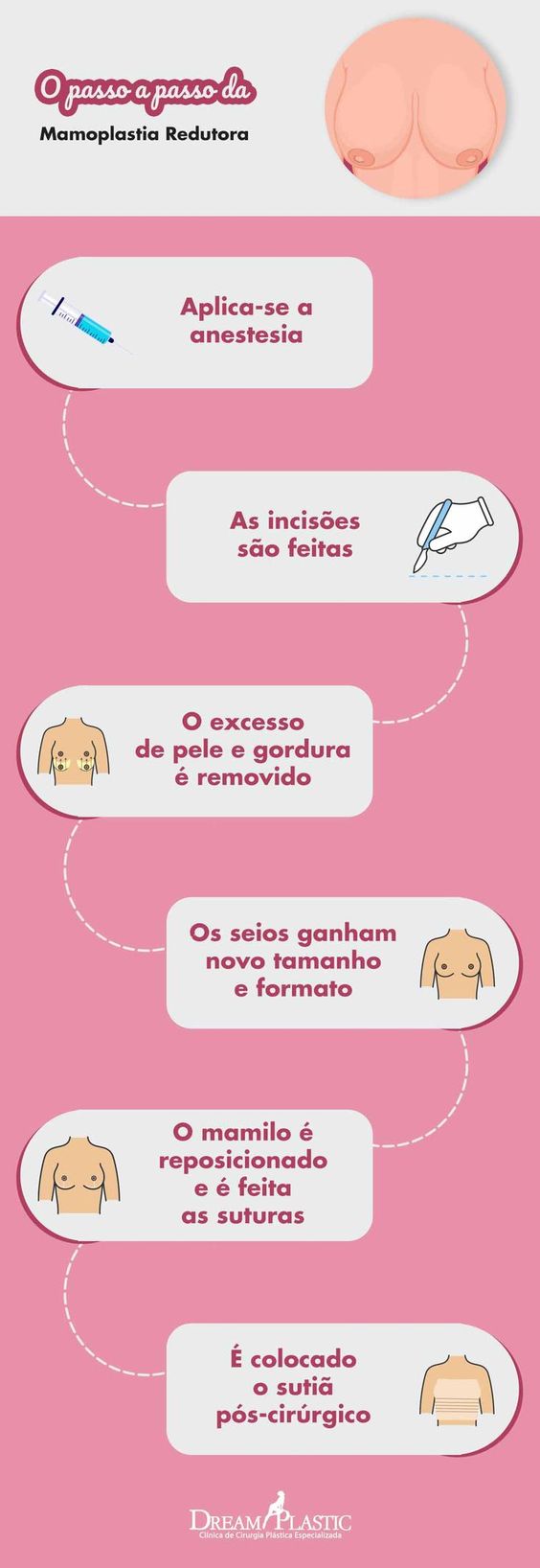 Infográfico que mostra o passo a passo da mamoplastia redutora