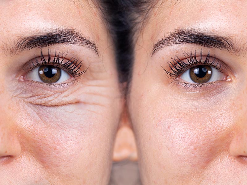 Você sabe o que é blefaroplastia? o que e blefaroplastia