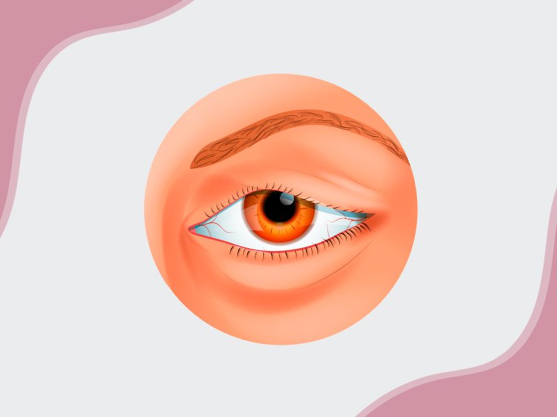 O que é ptose palpebral? ptose palpebral