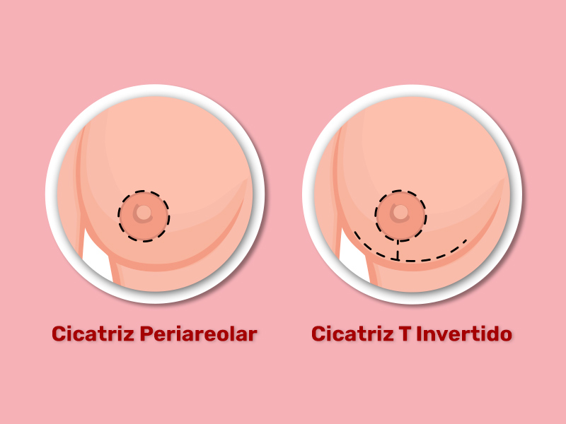 Dois seios, um com a cicatriz da mastopexia periarelorar, que é apenas em volta da aréola, e o outro com a cicatriz em T invertido, que desce em uma linha reta e depois forma uma linha no sulco mamário