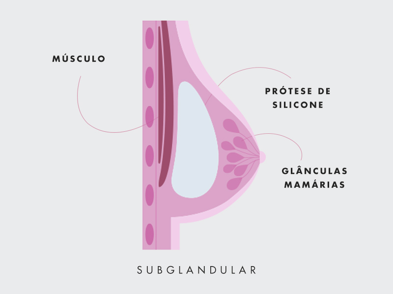 ilustração mostrando como fica o silicone por cima do musculo
