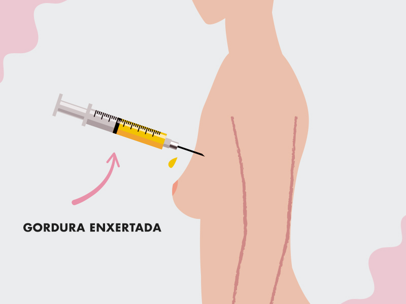 ilustração de enxerto de gordura quando poderia implante de silicone subglandular