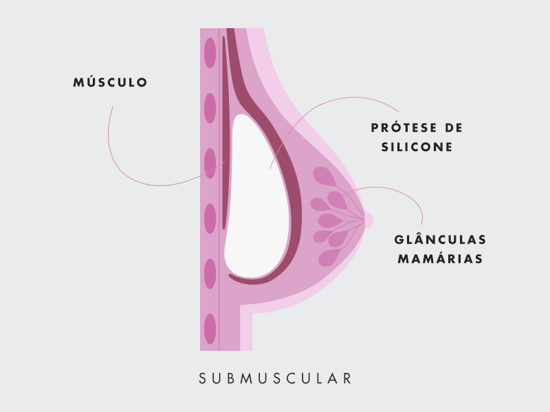 ilustração mostrando como fica o silicone por baixo do musculo
