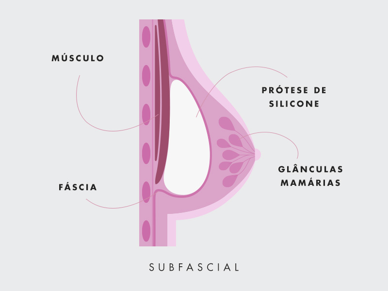 ilustração mostrando como fica o silicone subfascial