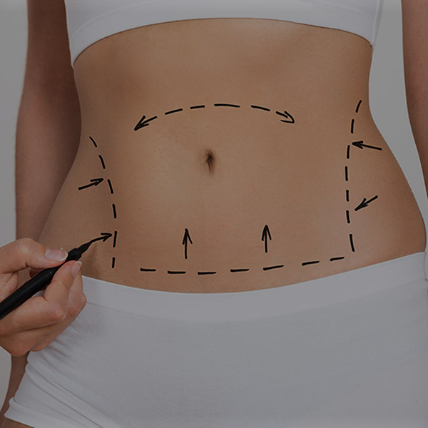 Abdominoplastia