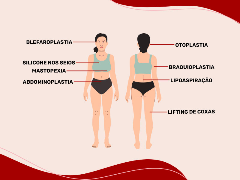 Ilustração com uma mulher de frente e de costas, com várias setinhas saindo dela, com o nome de algumas cirurgias plásticas, como silicone nos seios, blefaroplastia, lipoaspiração e abdominoplastia