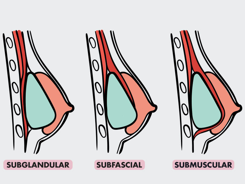 Ilustração com os tipos de colocação de prótese