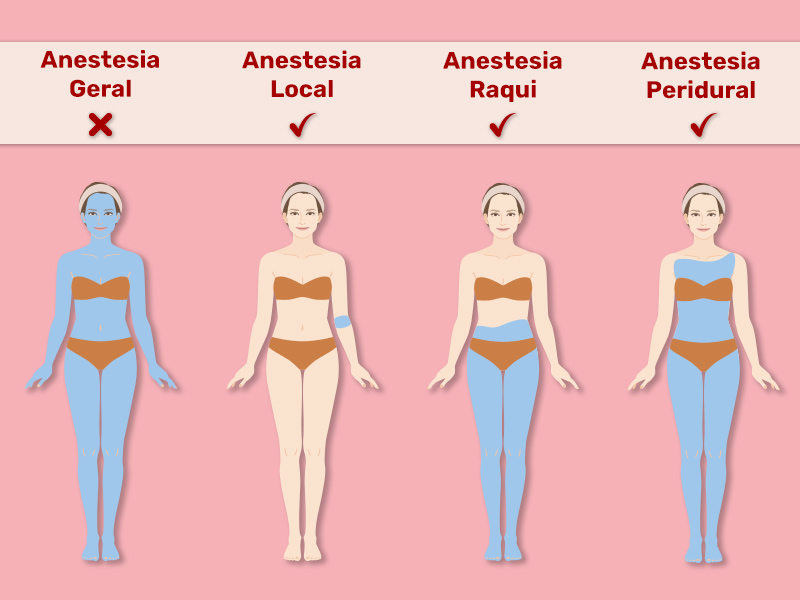 ilustração com os tipos de anestesia e quais são indicados para a cirurgia plástica, sendo a geral a única não indicada