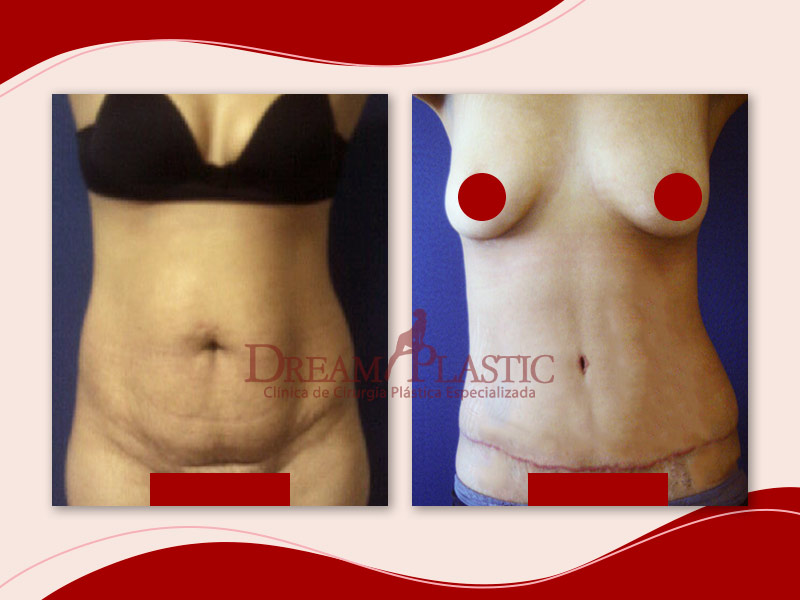 Antes e depois de paciente que fez abdominoplastia