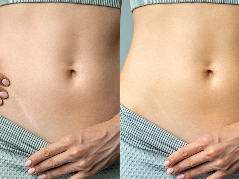 Barriga com cicatriz antes e depois do cicatricure